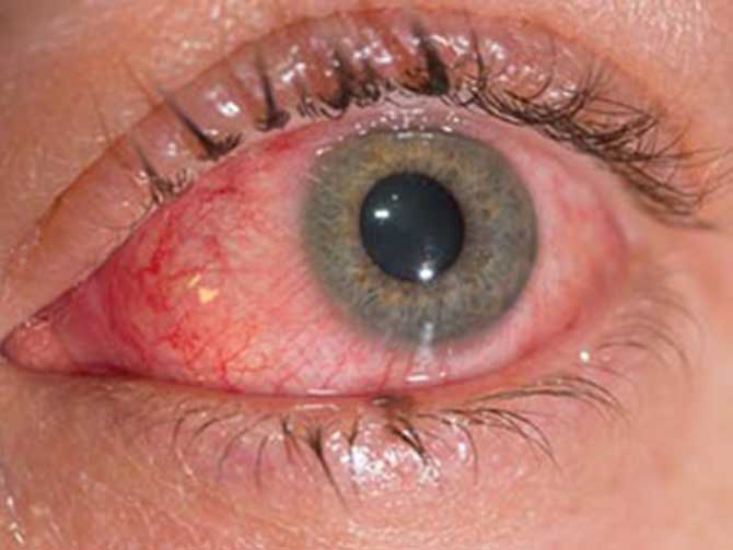 La conjuntivitis es otro síntoma de COVID 19